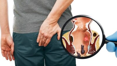 Jenis dan Harga Obat Ambeien di Apotik