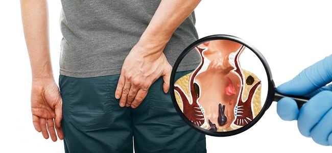 Jenis dan Harga Obat Ambeien di Apotik