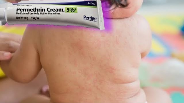 Ilustrasi Salep permethrin